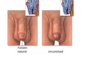 Cross-sections of an intact (uncircumcised) penis and a circumcised penis