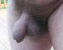 2 yr flaccid coverage side view foreskin restoration progress picture