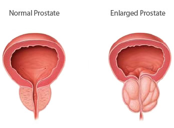 Normal prostate versus enlarged prostate (BPH)